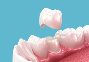 the pros and cons of getting a dental crown: is it worth it